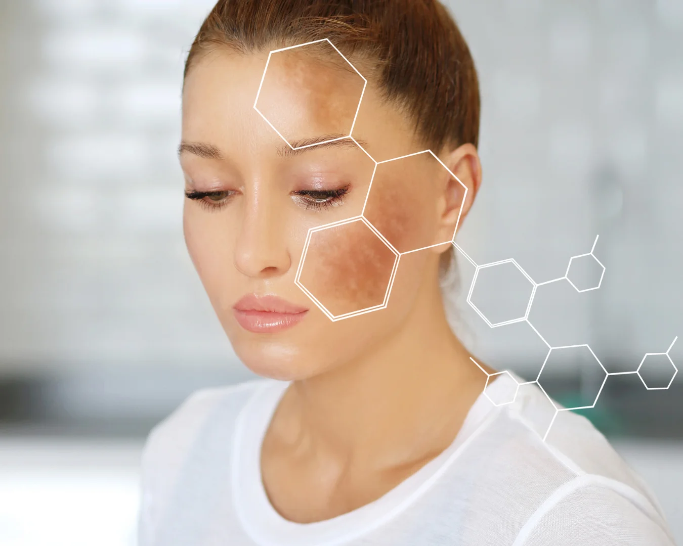 Tratamento para melasma com a Dra. Érika Voltan dermatologista em Moema SP