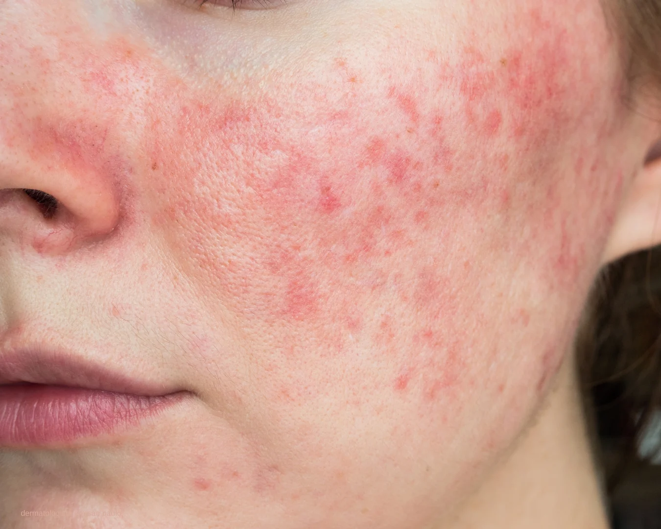 Tratamento para rosácea com a Dra. Érika Voltan, dermatologista especializada em pele sensível em Moema SP.