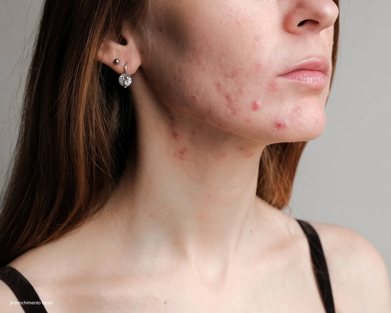 Tratamento para acne adulta com a Dra. Érika Voltan, dermatologista em Moema SP